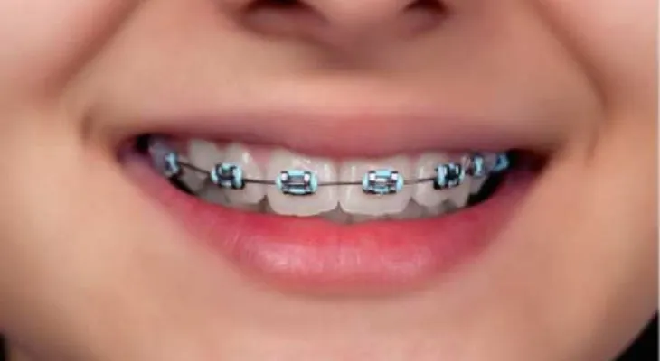 Tips para aliviar el dolor provocado por los brackets