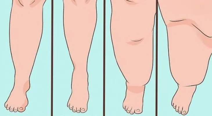 Lipedema ¿Qué es, y cómo saber si la padezco