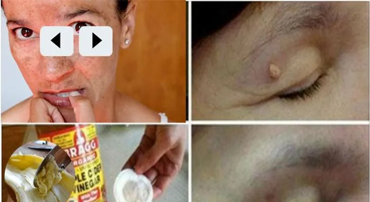 Como eliminar las verrugas, manchas y puntos negros de la piel con rapidez con estos remedios naturales