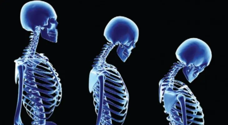 Día mundial de la osteoporosis: 10 consejos para minimizarla