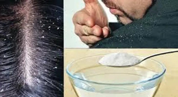 ¿Cómo quitar la caspa con bicarbonato y limón?