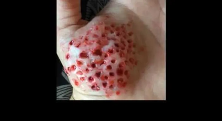 La picadura de este mosquito puede ser mortal y se riesga por el MUNDO (VIDEO)