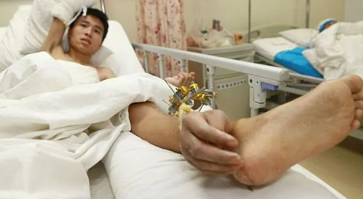 Le implantan una mano en el pie a un chino para mantenerlo con vida