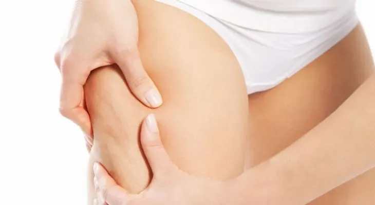 Estrías: ¿acabar con ellas o mostrarlas con orgullo?