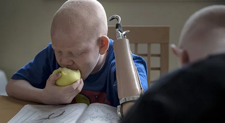 Las escalofriantes historias de los albinos en Tanzania (VIDEO)