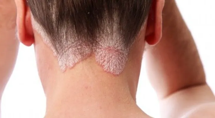 El Tratamiento Psoriasis debe ser para toda la vida