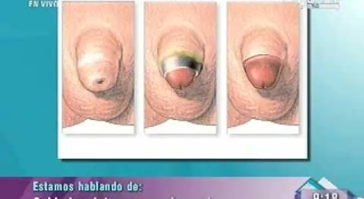 Cuidado del Pene No Circunciso (VIDEO)