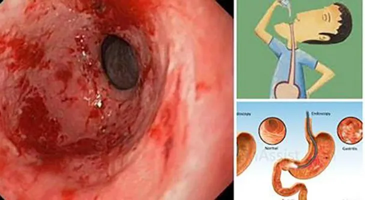 Este eficaz remedio cura la gastritis y la acidez de por vida