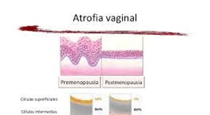 La atrofia vaginal provoca sequedad e inflamación: Causas y síntomas