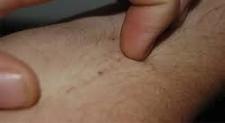 Si sientes picazón en la piel (prurito), estas pueden ser las causas: