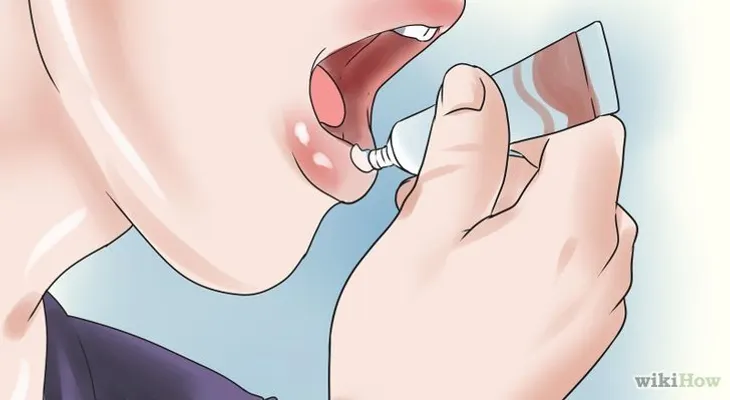 Las llagas de tu boca, quítala en 2 minutos 