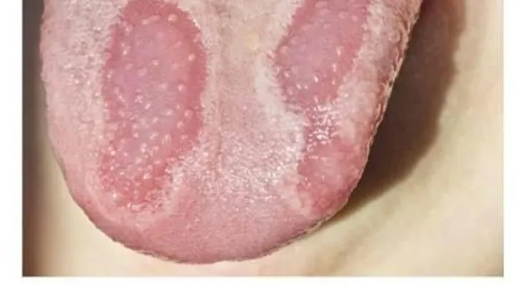 El misterioso trastorno que afecta a la lengua