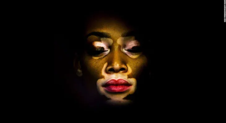 De ser llamada 'vaca' a chica de portada, la modelo Winnie Harlow cambia los estándares de belleza