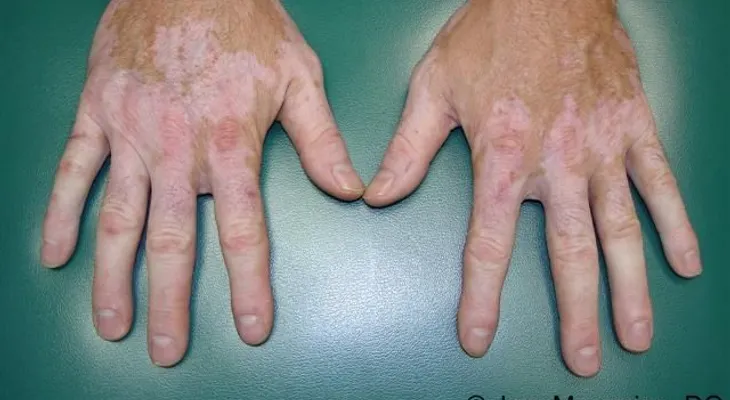 Efectivos remedios para manchas blancas en la piel (vitiligo)