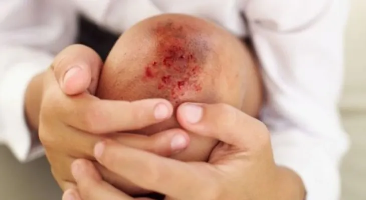 Hemofilia: Prevenir sangrado espontáneo desde la infancia evita el deterioro