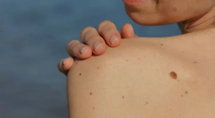Los lunares y las pecas; datos que seguramente no conocías