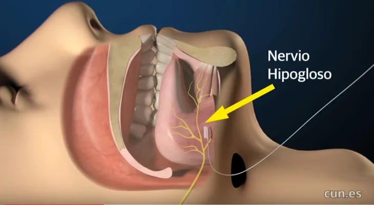 ¿Roncas mucho? Quizá sufres apnea del sueño