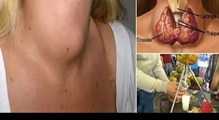 Esta es la solución para las tiroides inflamada, que los médicos nunca te dirán 