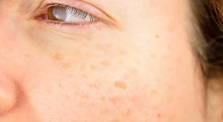 Seis tipos de manchas en la piel: ¿qué significan y cómo tratarlas?