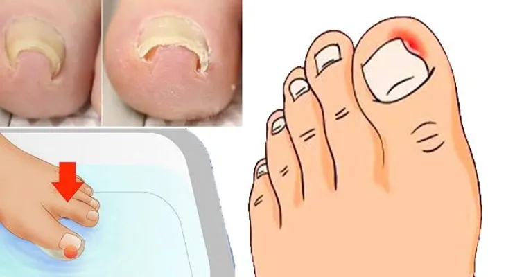 Como librarse con éxito de una uña encarnada. Receta