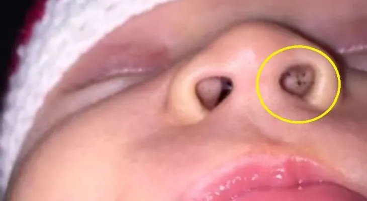 Una madre notó puntos negros en la nariz de su bebé.....cuidado con esto !!