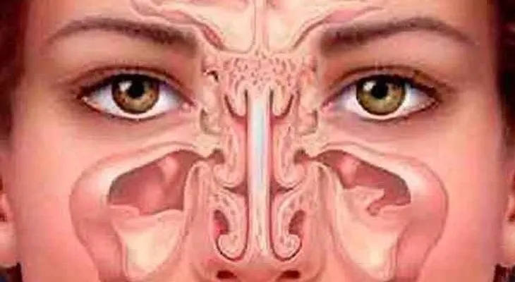 Para limpiar la Sinusitis: ingredientes 1 cebolla y 6 rábanos