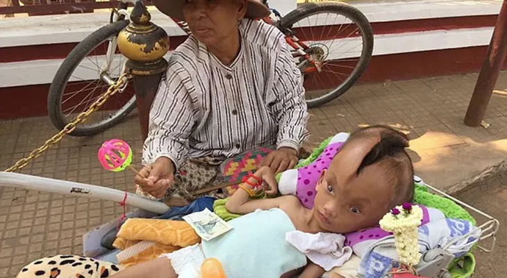 Familia del niño de Camboya con su cabeza partida en dos, busca ayuda desesperada 