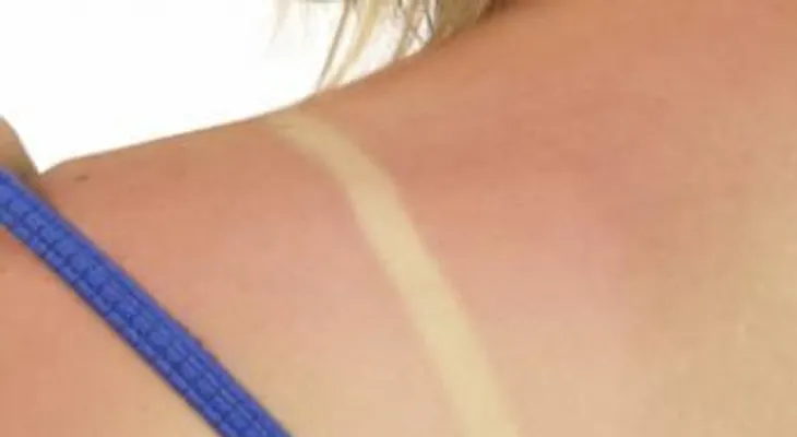 Qué debes hacer si te quemas al sol