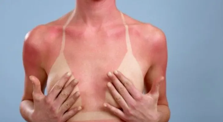 Quemaduras de sol provocan aparición de melanoma