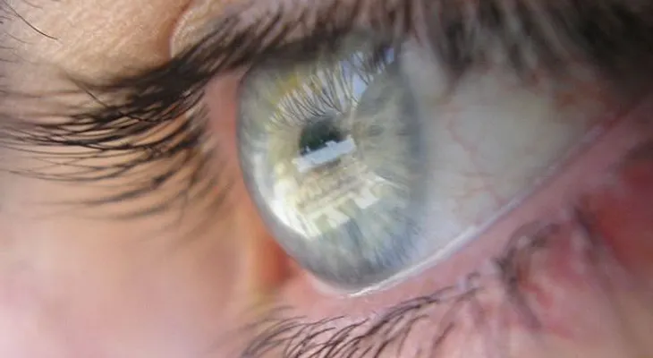 Identifican el gen de los ojos azules, las pecas y el pelo claro