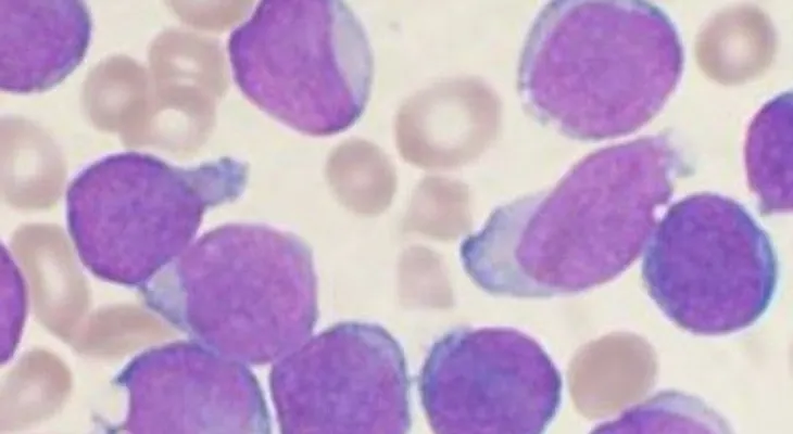 Científicos afirman que la leucemia puede devorarse