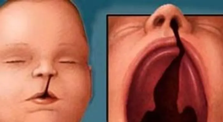 Reacción de esta pequeña tras ser operada de su labio leporino (Video)