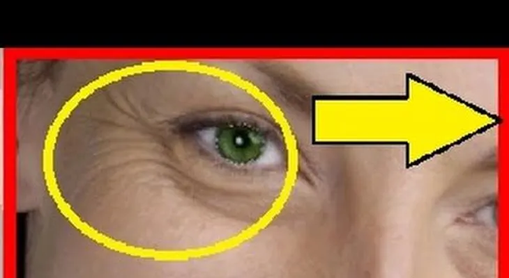 La forma de eliminar arrugas de los ojos