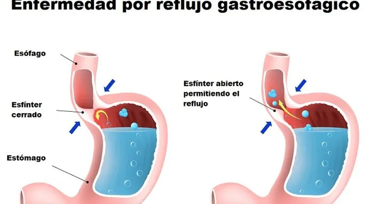 Lo que no sabes sobre la acidez estomacal