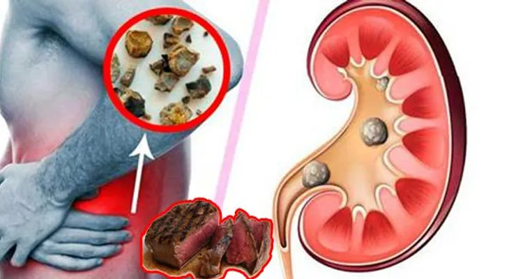 Urgente: estos son los alimentos que causan piedras en el riñón, deja de comerlos ahora!