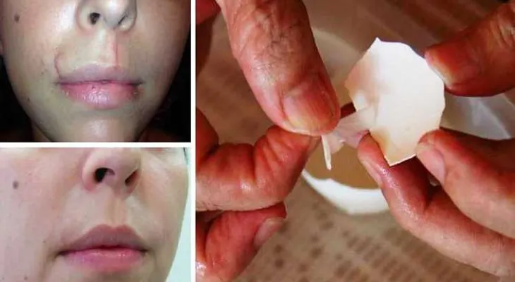 Increíble membrana para atenuar cicatrices y tratamiento para tu pelo: Descubre como usarla 