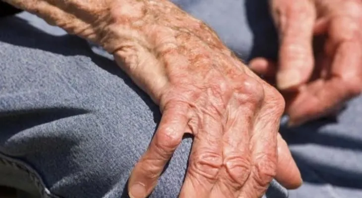 ¿Cómo vivir con Artritis Reumatoide?