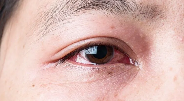 6 efectivos remedios para la conjuntivitis