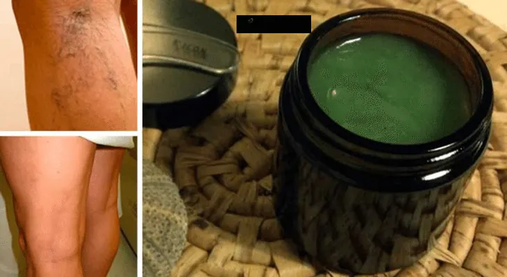  Mujer curó sus varices con esta antigua receta de la abuelita. Resultados casi inmediatos!