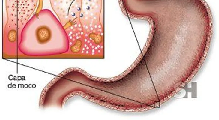 Enfermedad "rara" y "extraña" está produciendo gastritis, ulcera, pólipo y cáncer entre dominicanos 