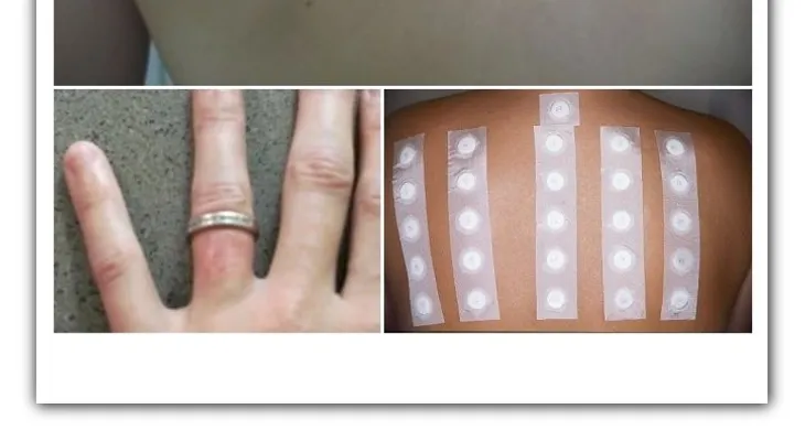 ¿Qué es la alergia al níquel, y cómo se cura? (VIDEO)