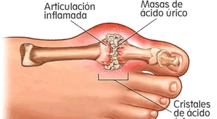 Artritis gotosa: causas, síntomas y tratamiento