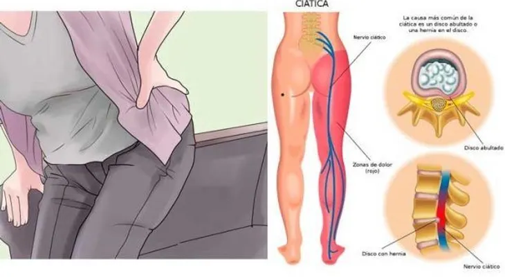 Nervio ciático: 2 simples ejercicios para recuperar la movilidad de inmediato?!