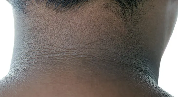 Oscurecimiento de parte posterior del cuello, alerta de prediabetes