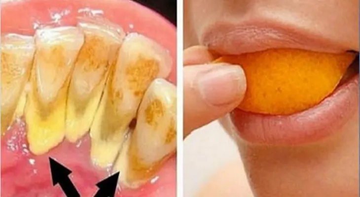 Elimina el sarro y blanquea tus dientes en 15 min con esta receta
