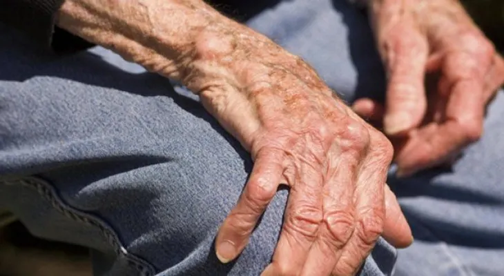 Entérate aquí cómo vivir con artritis reumatoide y sus recomendaciones