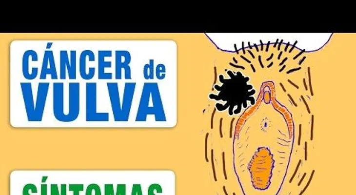 Aprende las señales para detectar un cáncer de vulva, sin tener que ir a un médico