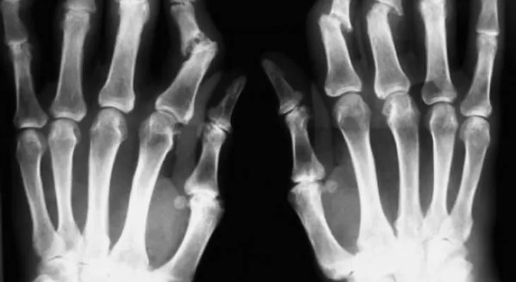 Artritis psoriásica: inflamación y deformación articular
