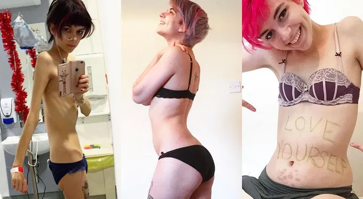Una joven muestra en fotos cómo se recupera de la anorexia: "Se puede volver a ser feliz"