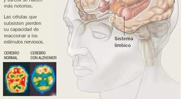 Fisioterapia en la enfermedad de Alzheimer